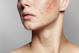 Casting : femmes et hommes de 18 à 30 ans avec peau à tendance acnéique pour une campagne pub